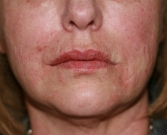 Feel Beautiful - Restylane in creases at sides of lips - After Photo